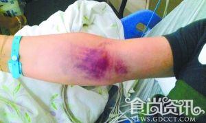 男子吃羊肉串现瘀斑 “羊肉”或为鼠肉